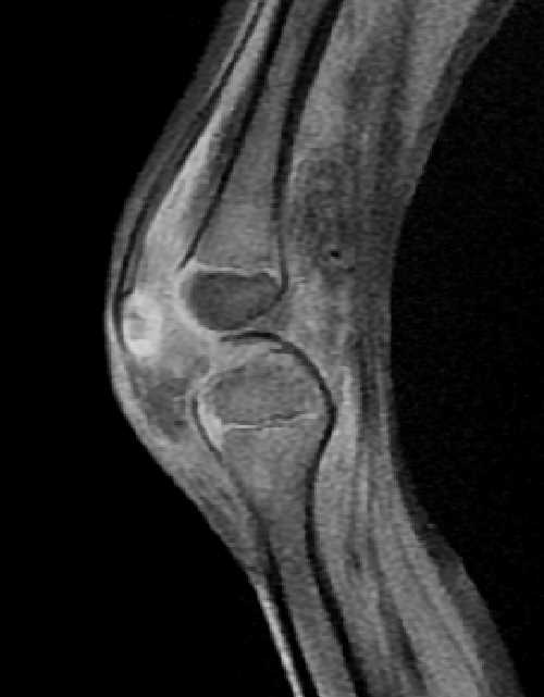 Septic arthritis of the knee - pediatric | Image | Radiopaedia.org