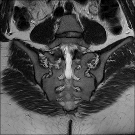 Normal sacroiliac joint (MRI) | Image | Radiopaedia.org