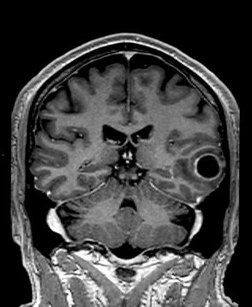 Glioblastoma IDH wild-type | Radiology Case | Radiopaedia.org