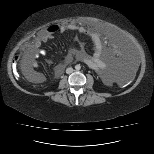 Omental cake - breast cancer metastases | Image | Radiopaedia.org