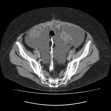 Omental cake - breast cancer metastases | Radiology Case | Radiopaedia.org