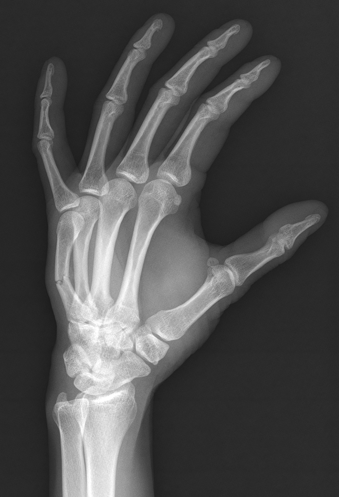 Metacarpal Fracture Image