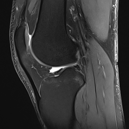 Iliotibial Band Friction Syndrome 