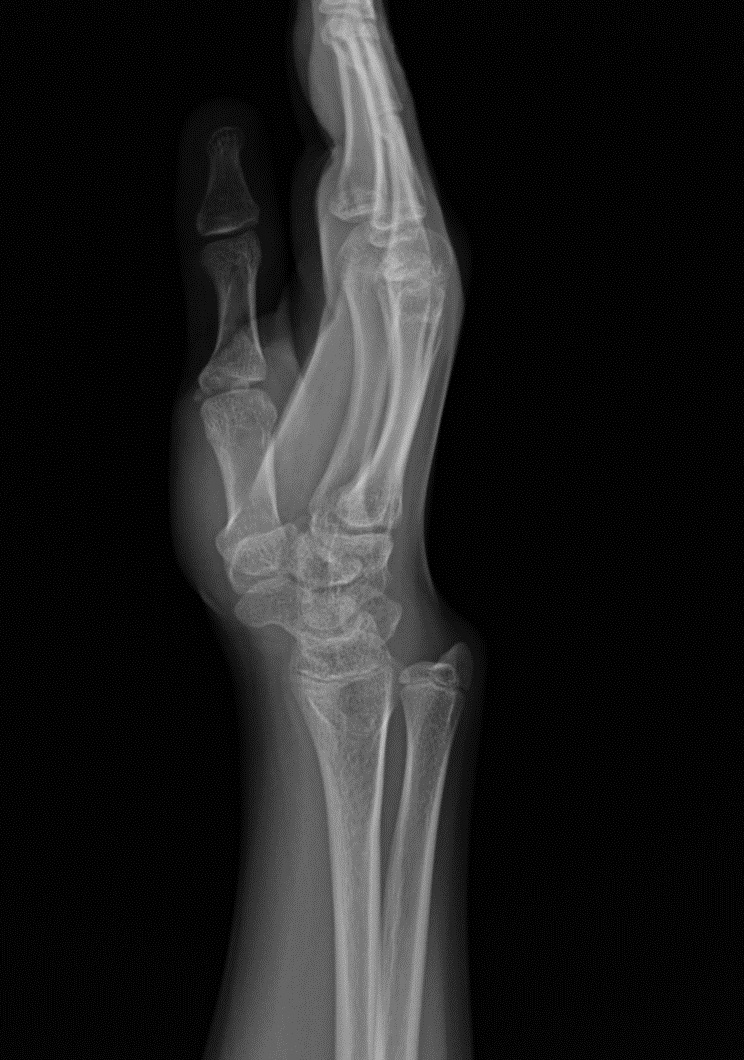 Madelung deformity | Image | Radiopaedia.org