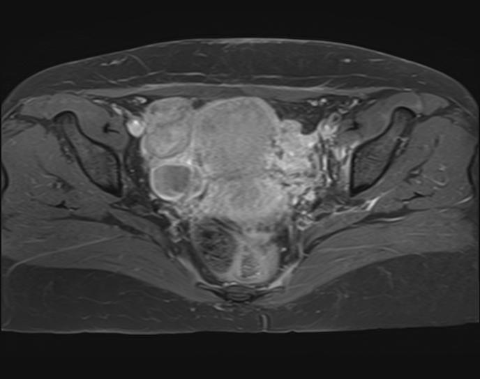 Septic arthritis of the sacroiliac joint and pubic symphysis | Image ...