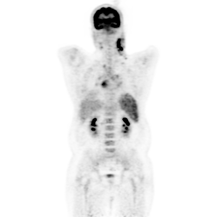 hodgkin's lymphoma case study