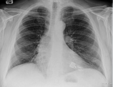 Reveal Plus ILR | Radiology Case | Radiopaedia.org