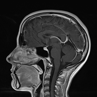 Multinodular and vacuolating neuronal tumor | Image | Radiopaedia.org