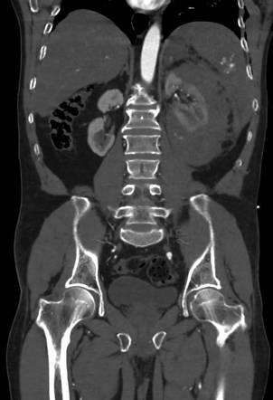 Muscle Injury  Radiology Key