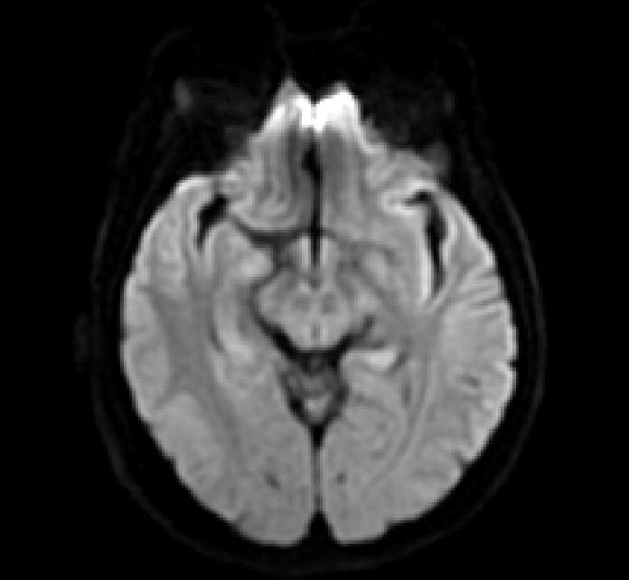 Recurrent Cholesteatoma 