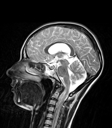 Closed lip schizencephaly | Image | Radiopaedia.org