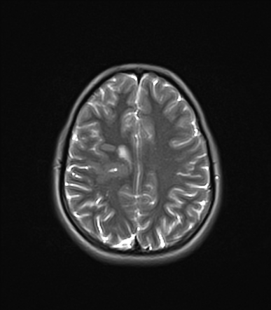 Closed lip schizencephaly | Radiology Case | Radiopaedia.org