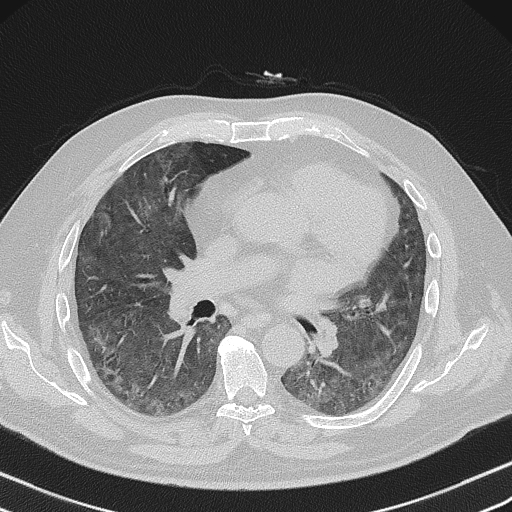 Non specific interstitial pneumonia (NSIP) | Image | Radiopaedia.org