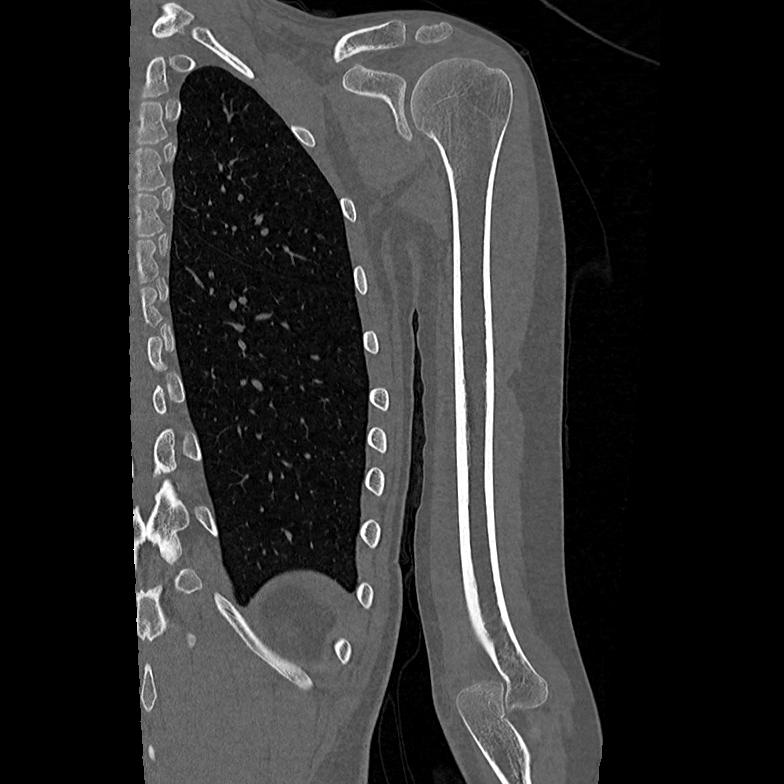 Juxtacortical chondroma | Image | Radiopaedia.org