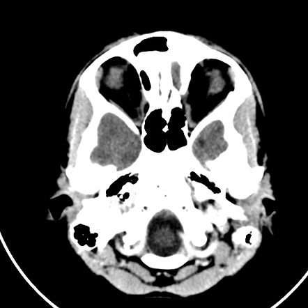 Dacryocystitis - Pediatric | Image | Radiopaedia.org