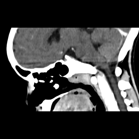 Dacryocystitis - Pediatric | Image | Radiopaedia.org