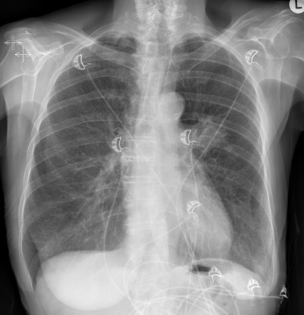 Metastatic lung cancer | Radiology Case | Radiopaedia.org