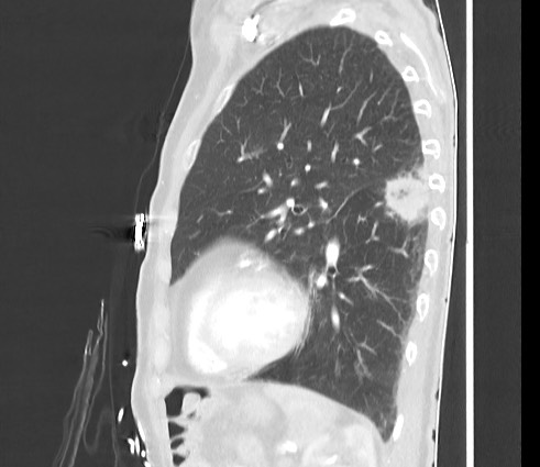 Metastatic lung cancer | Image | Radiopaedia.org