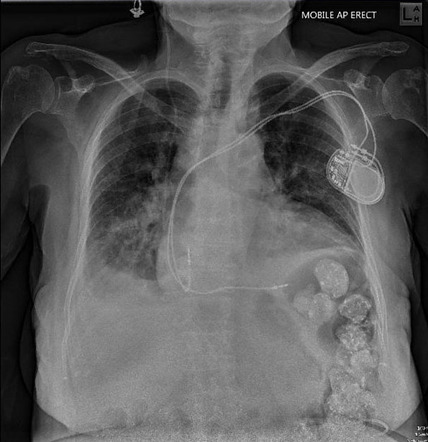 Fecal loading and phosphate binders | Image | Radiopaedia.org