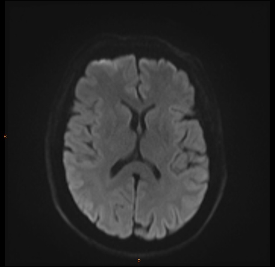 Middle cranial fossa meningoencephalocele | Image | Radiopaedia.org