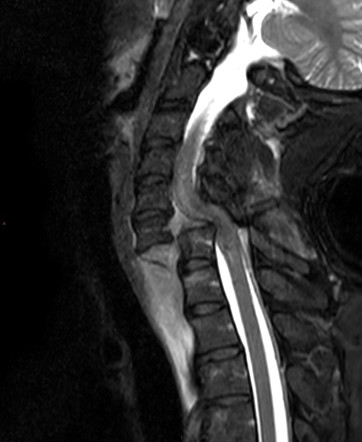 C6/C7 fracture dislocation with cord hematoma | Image | Radiopaedia.org