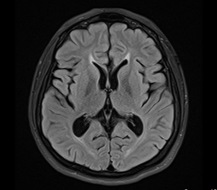 Ears of the lynx sign (brain) | Radiology Reference Article ...