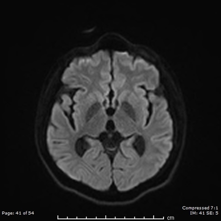 Hereditary spastic paraplegia with thin corpus callosum | Image ...