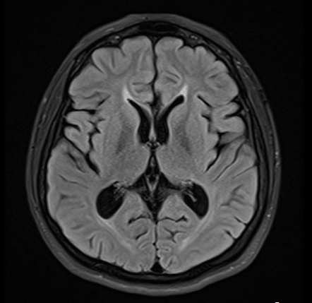 Hereditary Spastic Paraplegia 