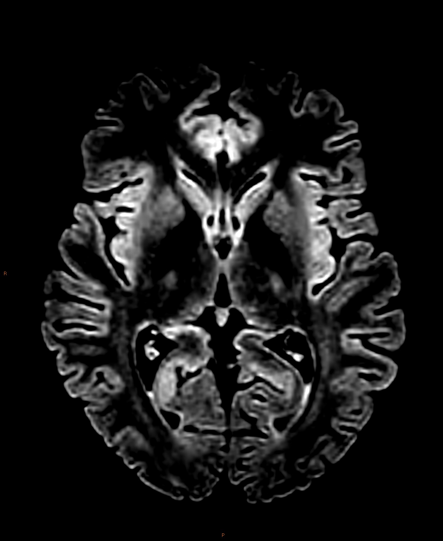 Normal Mri Epilepsy Protocol Image 9253