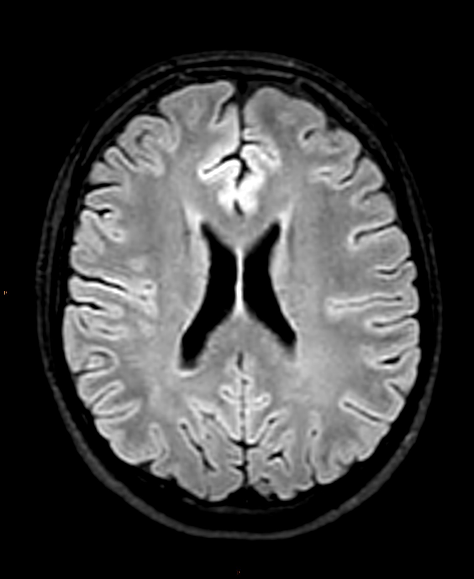 Normal MRI epilepsy protocol | Image | Radiopaedia.org