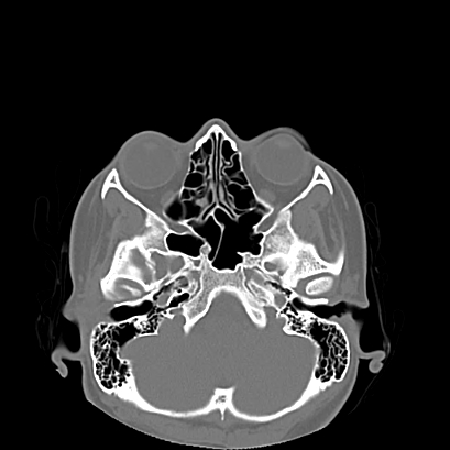 Normal paranasal sinuses (CT) | Image | Radiopaedia.org