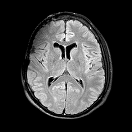 Neuro-Behçet disease | Image | Radiopaedia.org