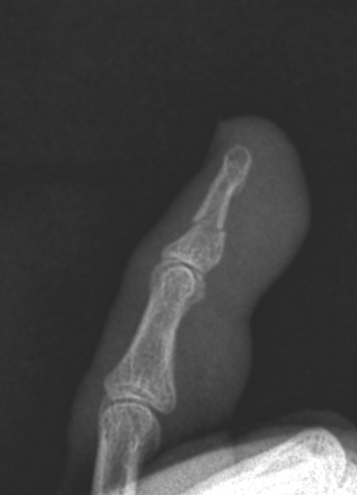 Fifth distal phalanx fracture | Image | Radiopaedia.org