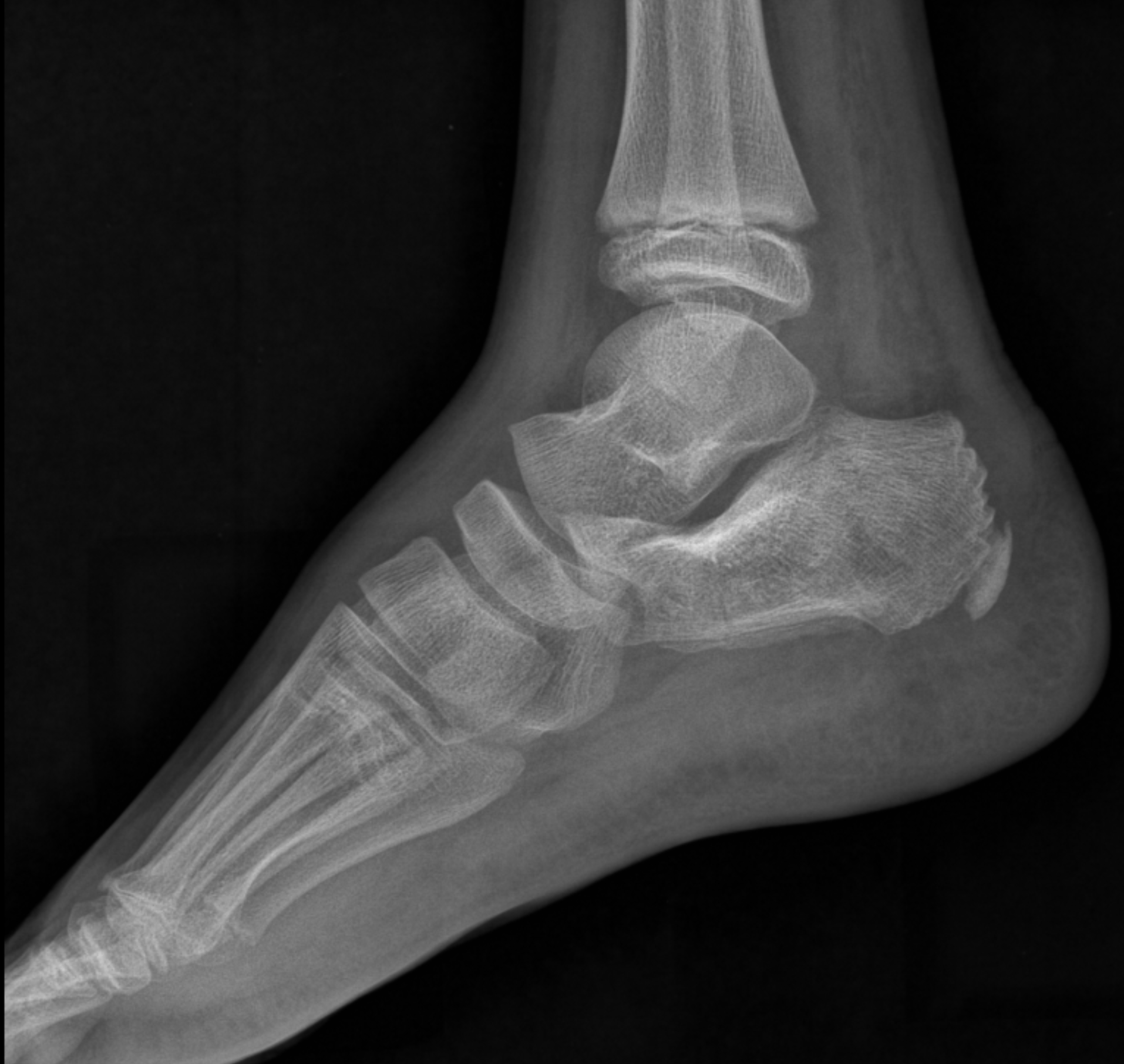 Calcaneus Fracture 