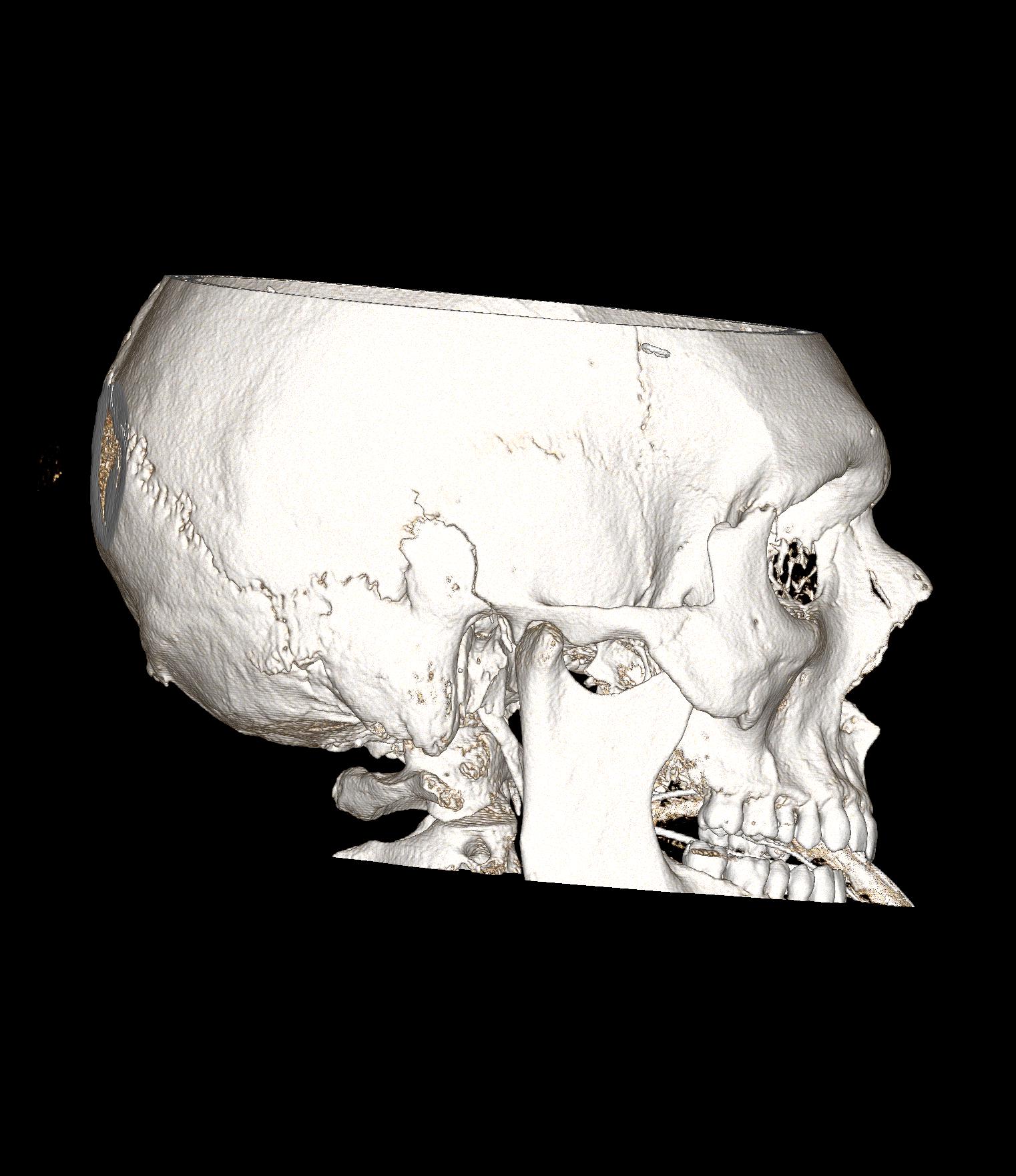 Transverse transsphenoidal basilar skull fractures with carotid ...