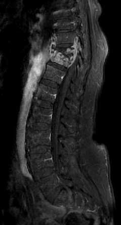 Spondylodiscitis - Thoracic Spine | Radiology Case | Radiopaedia.org