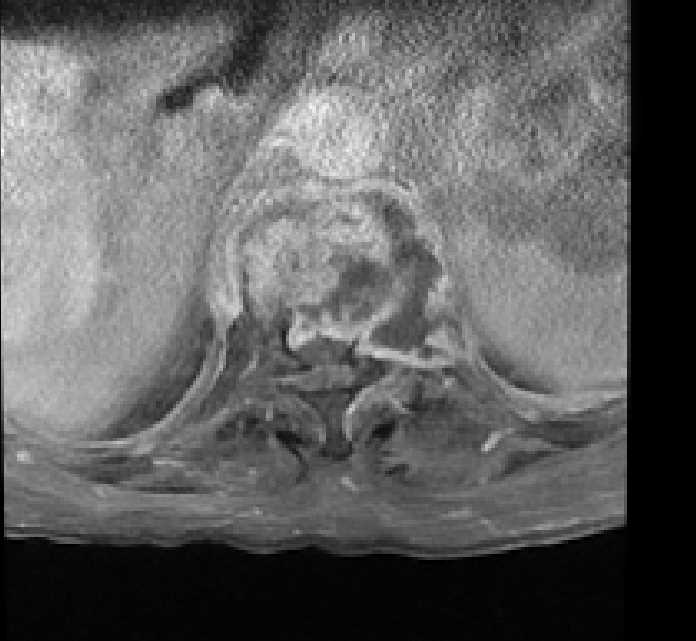 Spondylodiscitis - dorsal spine | Image | Radiopaedia.org