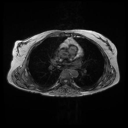 Bilateral elastofibromas dorsi | Radiology Case | Radiopaedia.org