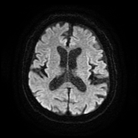 Pituicytoma | Image | Radiopaedia.org