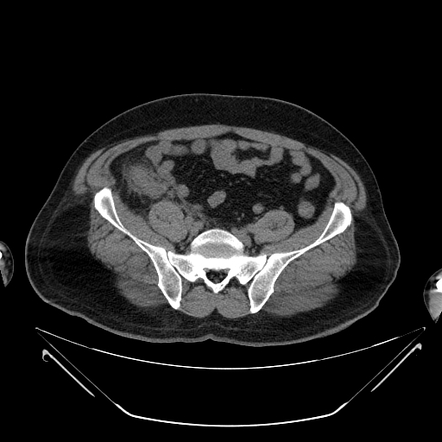 Acute Appendicitis | Radiology Case | Radiopaedia.org