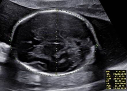 Second trimester ultrasound scan | Radiology Reference Article ...