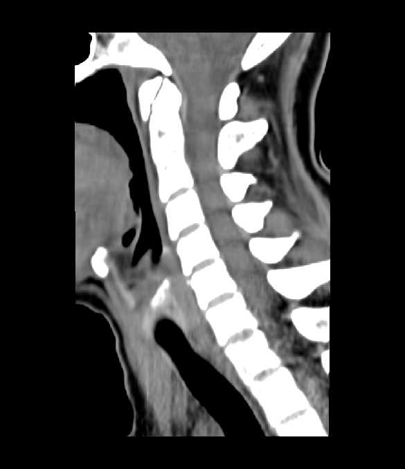 Congenital Cervical Fusion