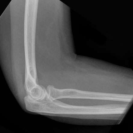 Radial Neck Fracture Radiology Case Radiopaedia Org