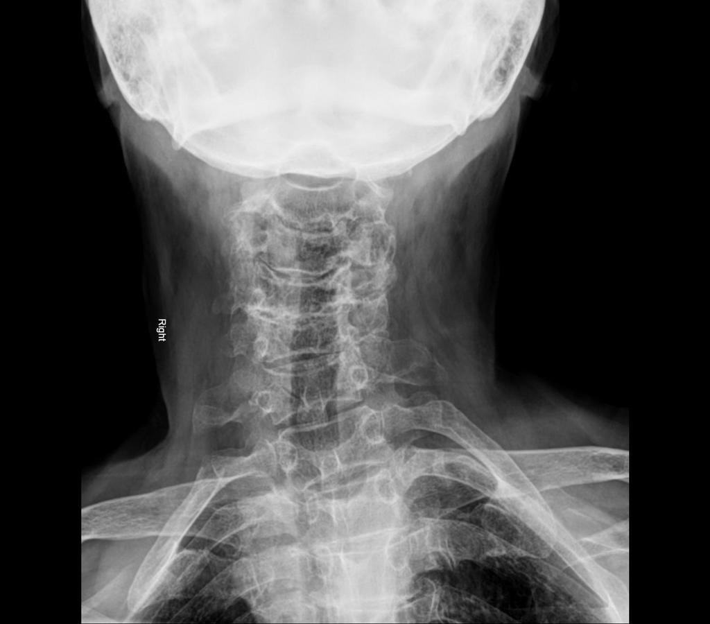 Advanced Cervical Spine Degenerative Changes Radiology Case Radiopaedia Org