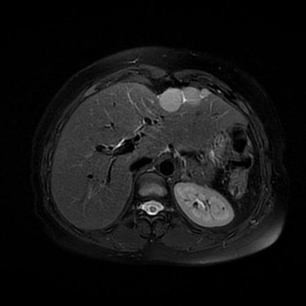 Abdominal splenosis | Radiology Case | Radiopaedia.org