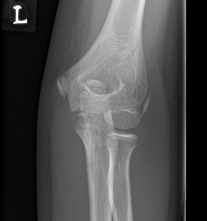 Normal elbow - 10-year-old | Radiology Case | Radiopaedia.org