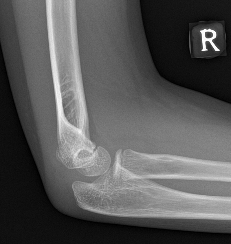 Normal Elbow X Ray 10 Years Old Image