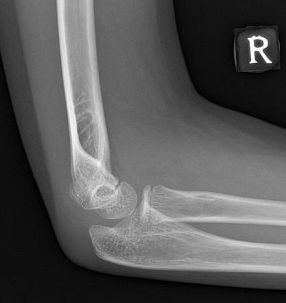 Normal elbow x-ray - 10-years-old | Image | Radiopaedia.org