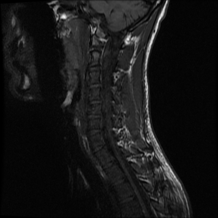 Cervical vertebral burst fracture | Image | Radiopaedia.org