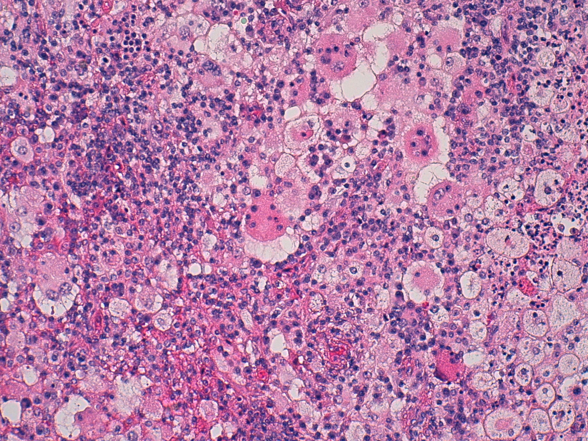 Rosai Dorfman Disease Of The Breast Image